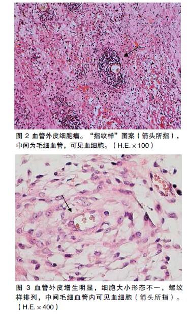 血管外皮细胞瘤病例分析